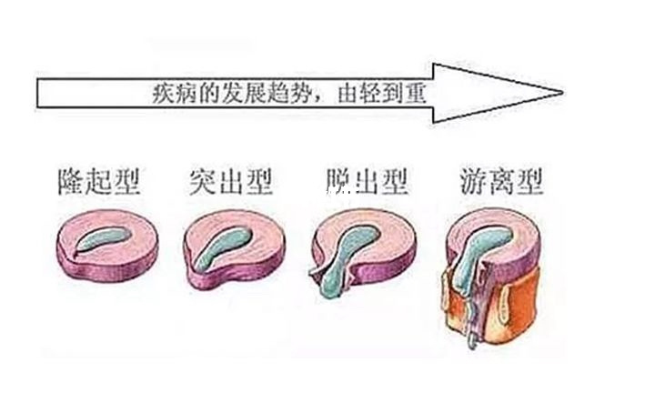 腰椎間盤突出,錘療,錘正療法